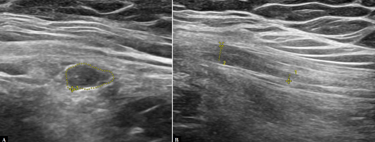 Meralgia parestesica tempo formacion ecografia 3.jpg
